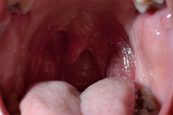 tonsils_inset_1k