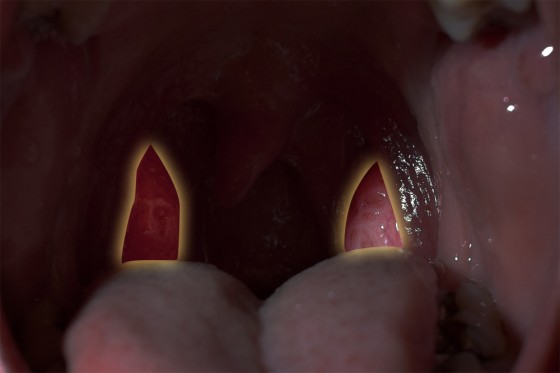 tonsils_inset_highlight_1k